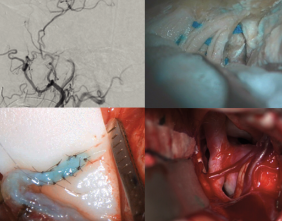 International skull base and vascular dissection course