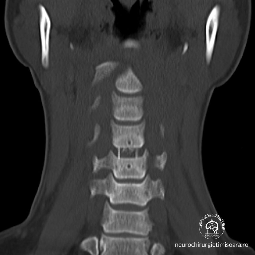 Patologie degenerativa coloana 10