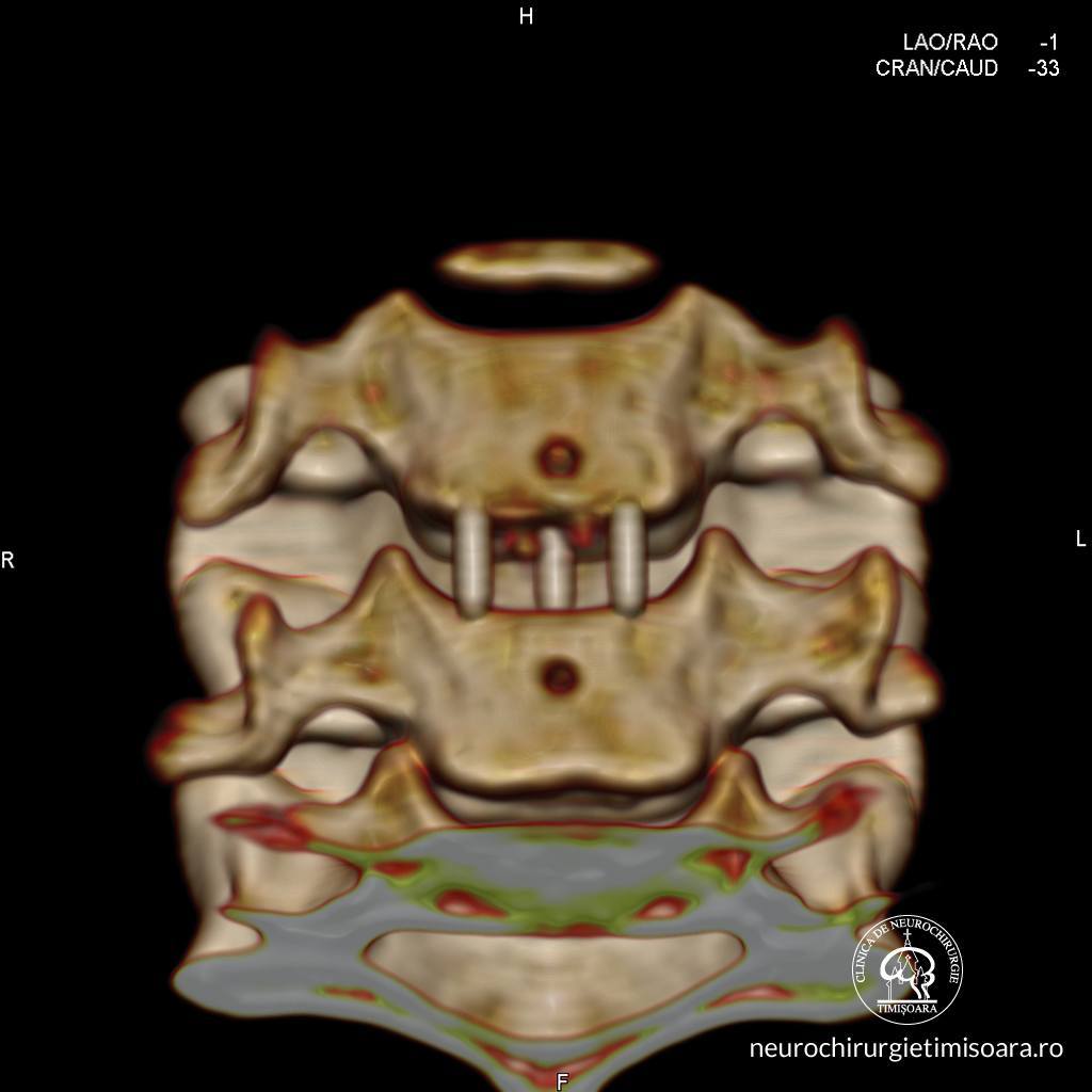 Patologie degenerativa coloana 11