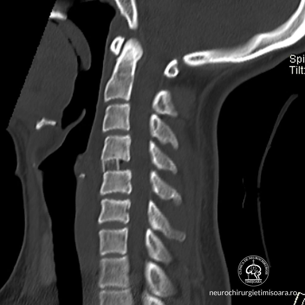 Patologie degenerativa coloana 12