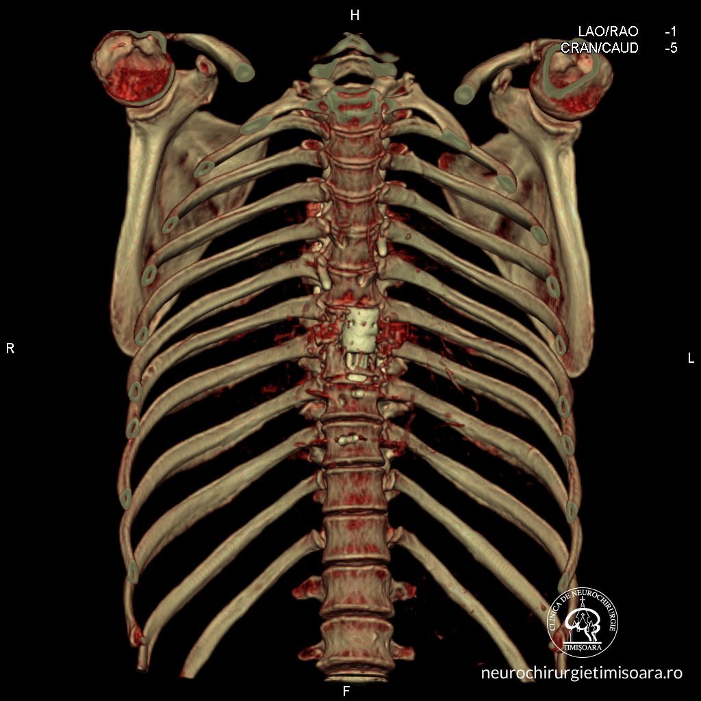 Patologie degenerativa coloana 3