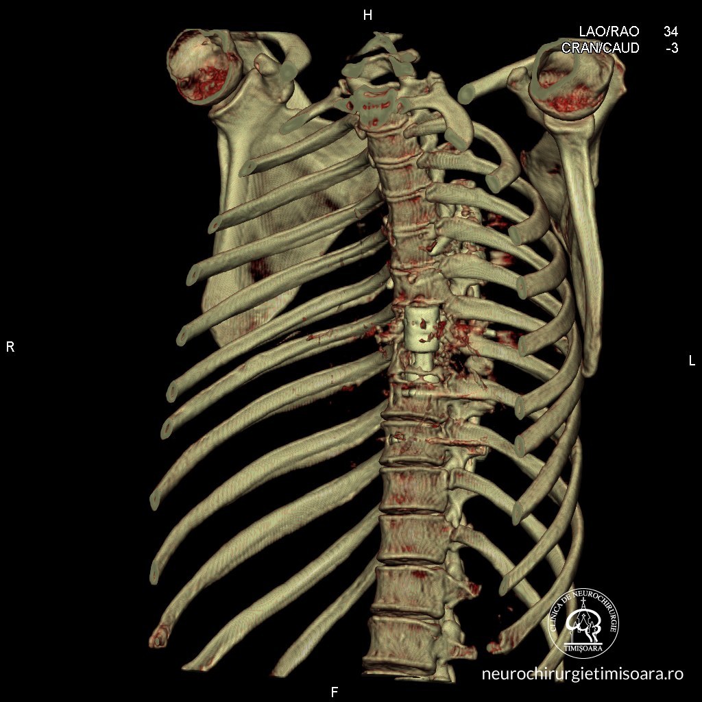 Patologie degenerativa coloana 4