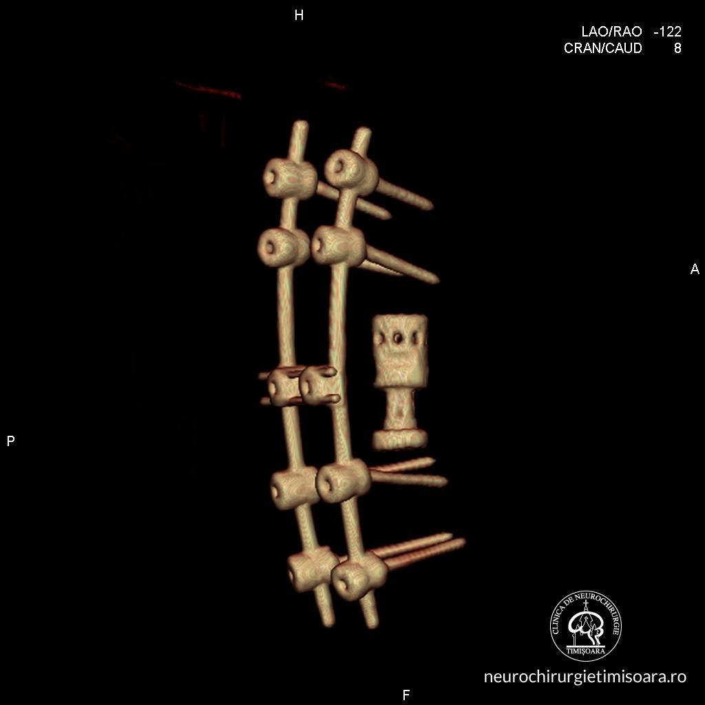 Patologie degenerativa coloana 5