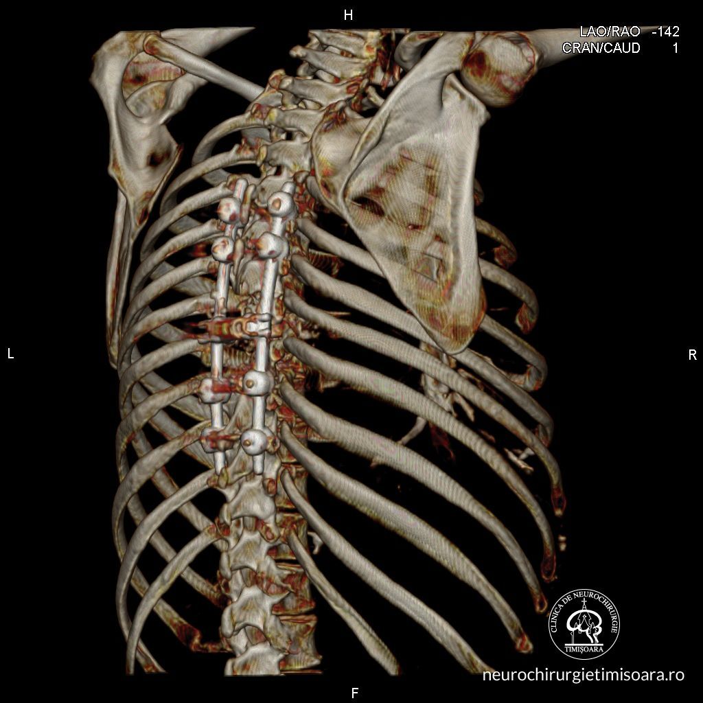 Patologie degenerativa coloana 6