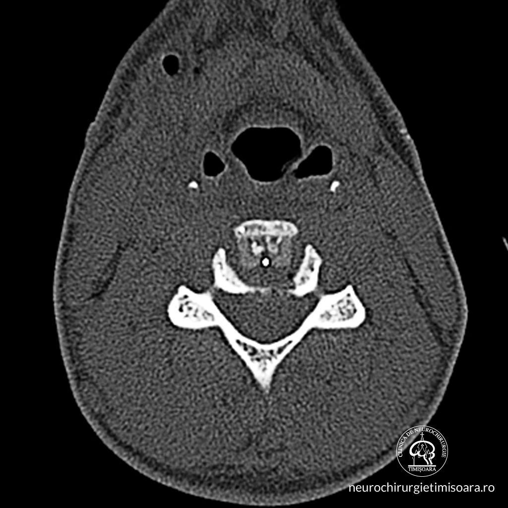 Patologie degenerativa coloana 8