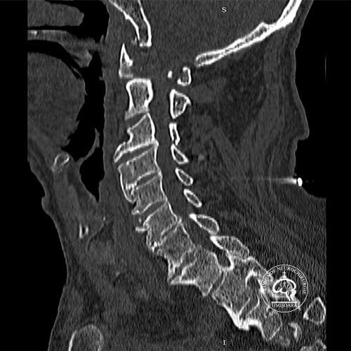 Fractura C1 preooperator