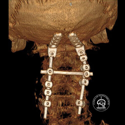 Fractura C1 preooperator