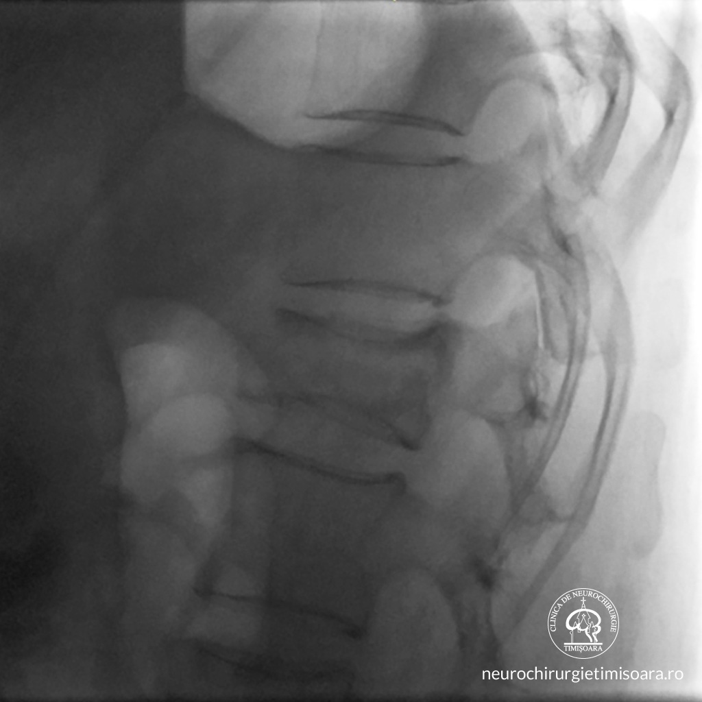 Patologie traumatica coloana 1
