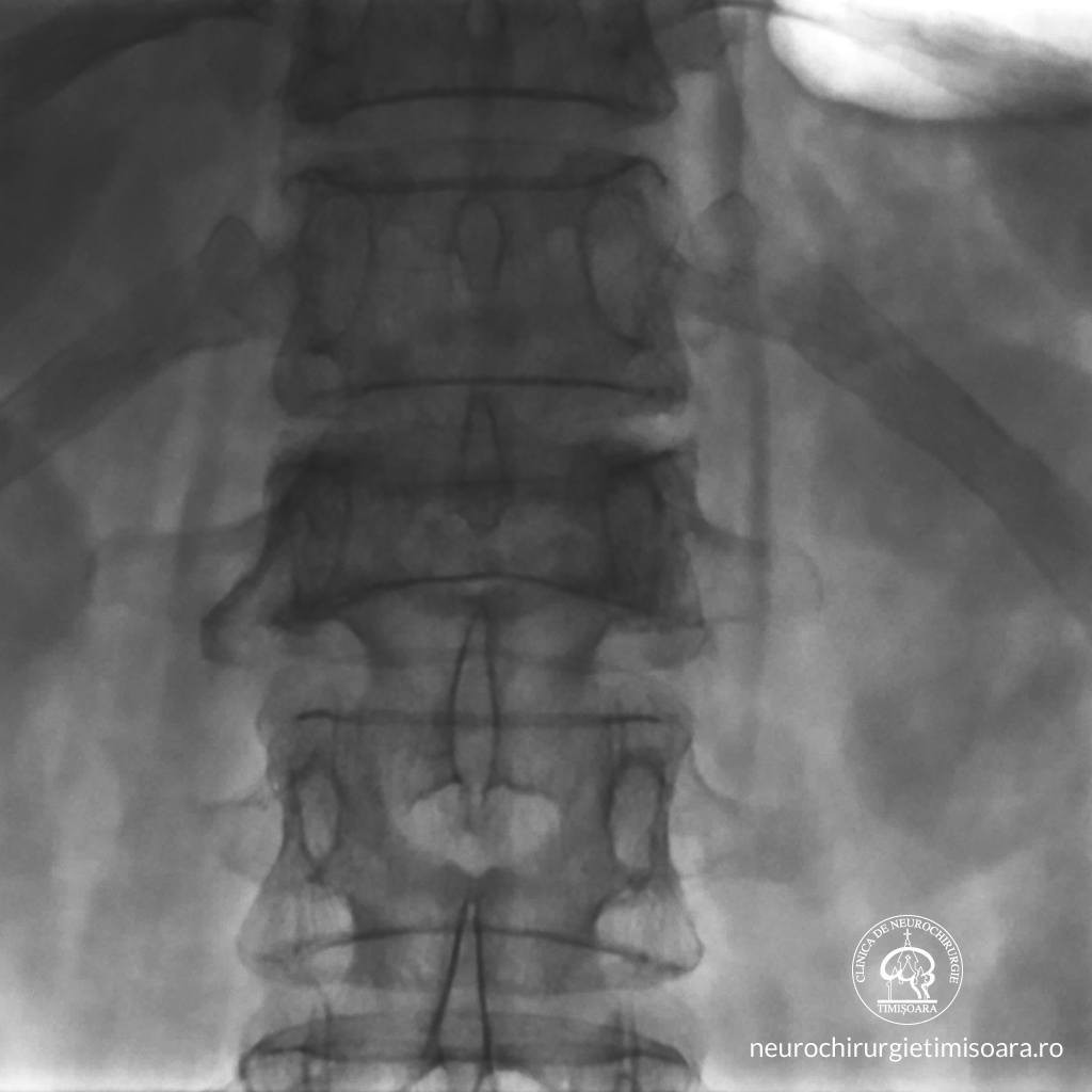 Patologie traumatica coloana 2