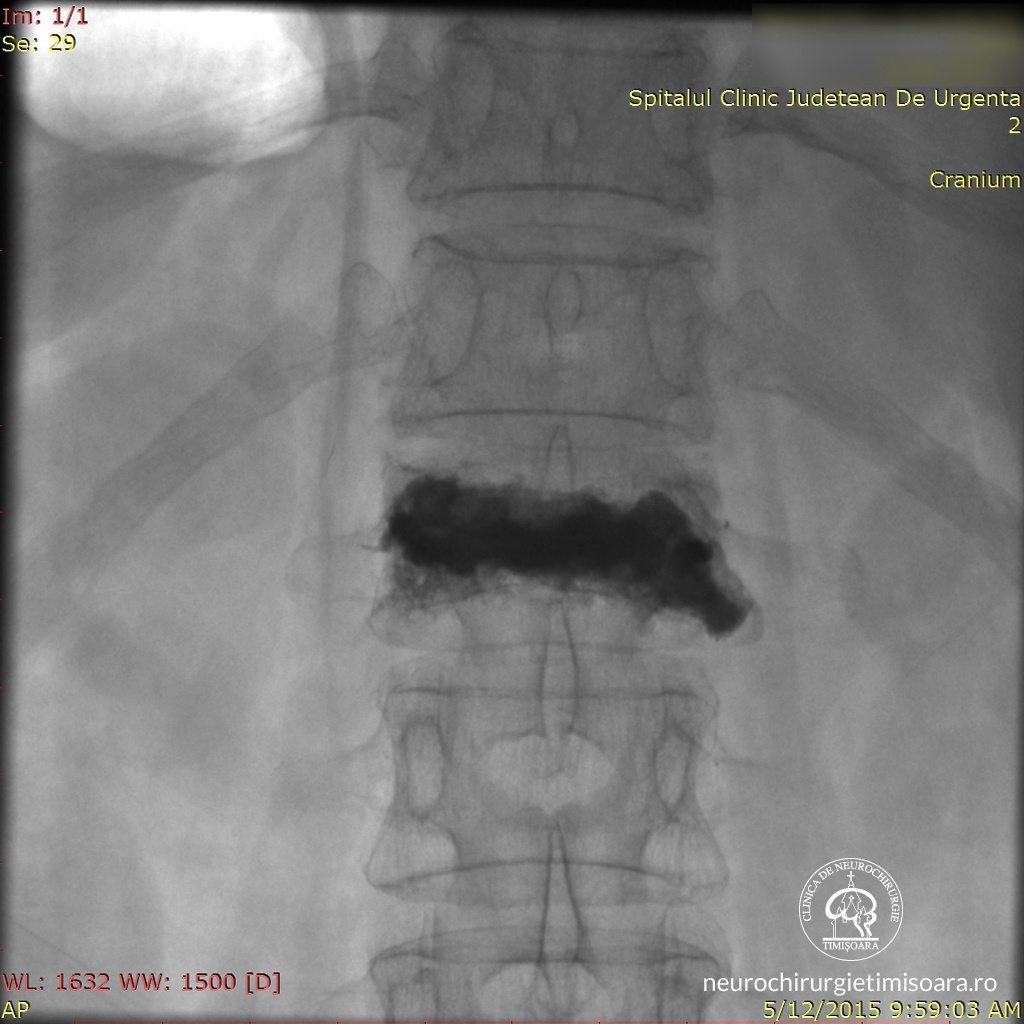 Patologie traumatica coloana 6