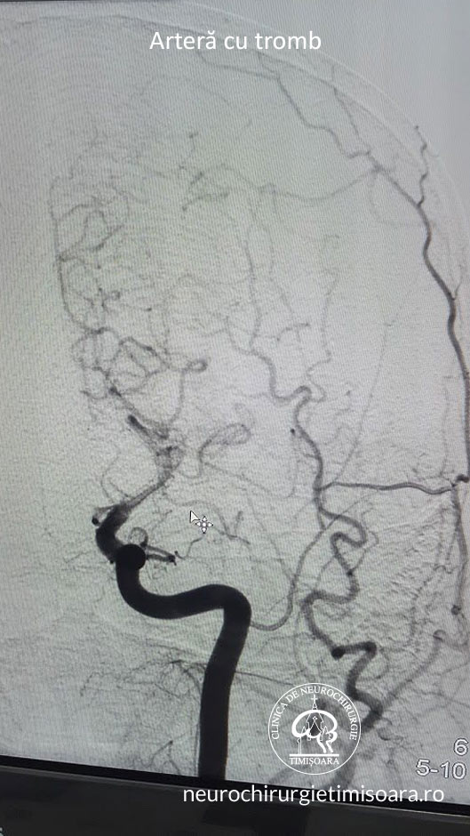 Trombectomie mecanica - Tromboza de artera carotida interna stanga