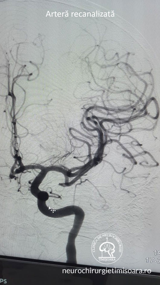 Trombectomie mecanica - Tromboza de artera carotida interna stanga