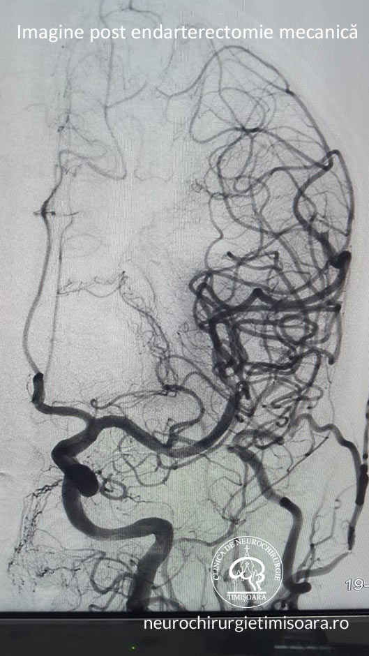 Trombectomie mecanica  - Tromboza de artera Sylviana stanga